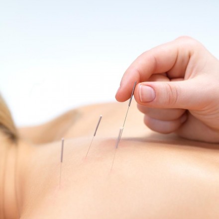 Acupuncture